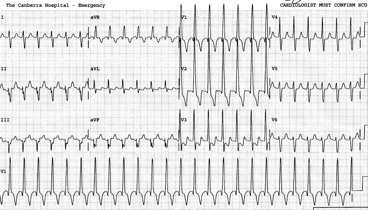 12 year old girl, several years after a Fontan procedure