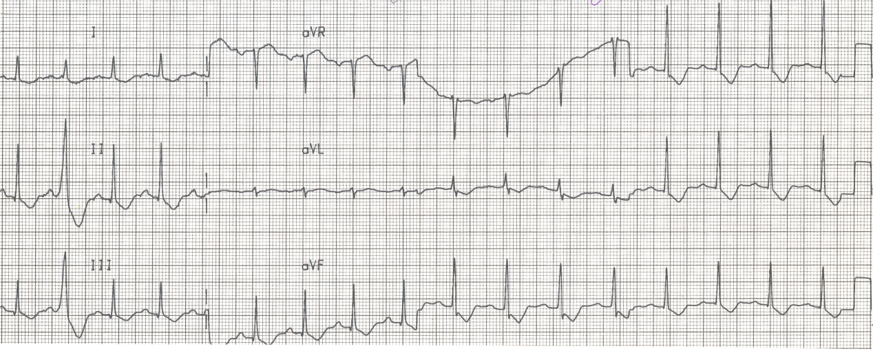 34 year old man with atypical chest pains. He had been taking large doses of a cough medicine containing pseudoephedrine.