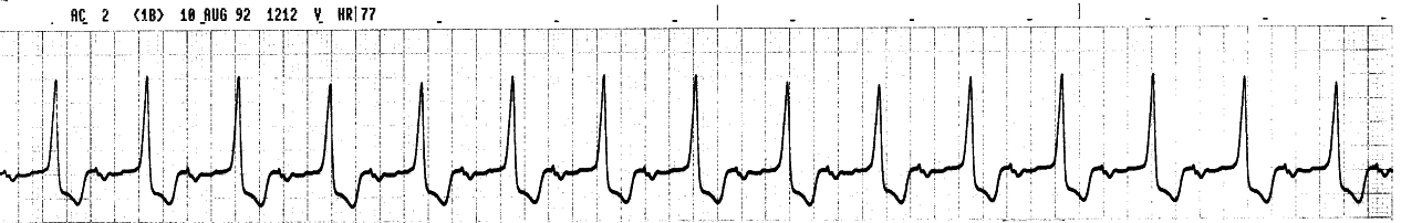 The longest PR interval reported is 1.10â!92