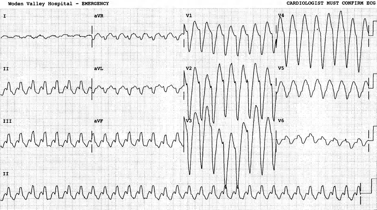 67 year old heavy drinker with COAD and echocardiographic fractional shortening of only 13%. 