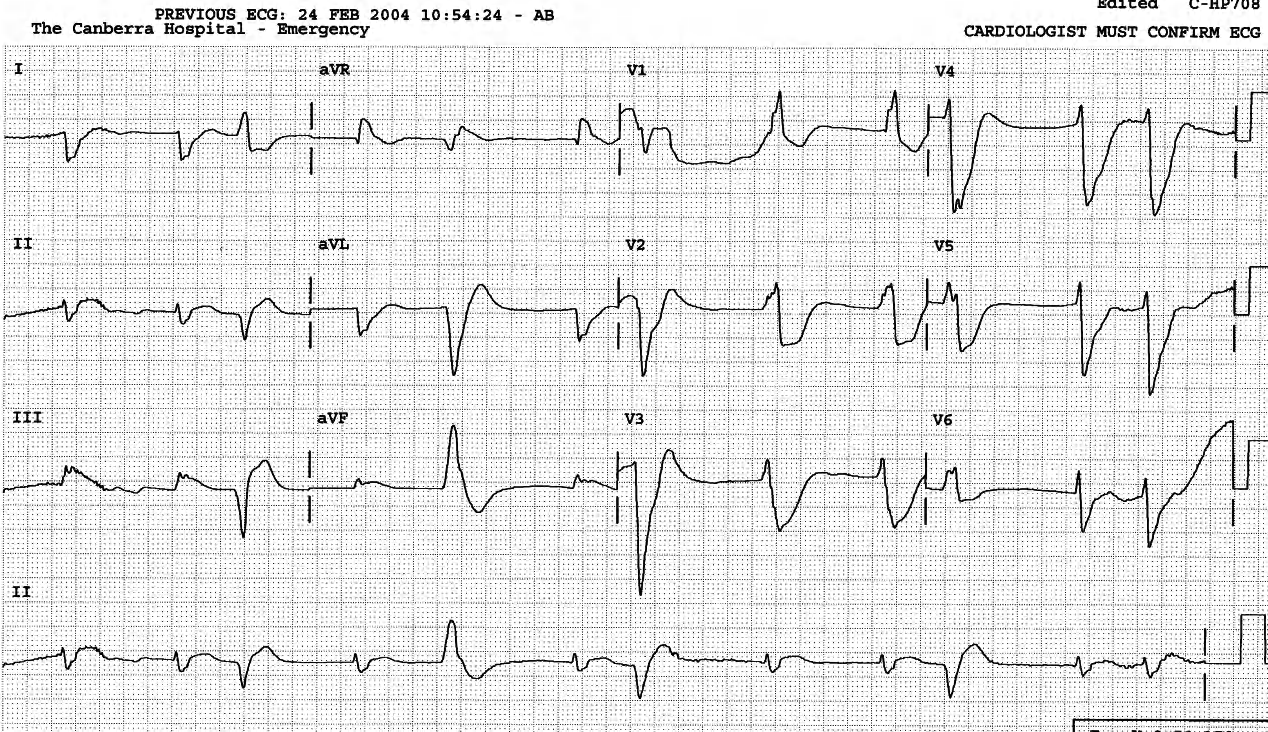 Large inferior infarct pattern fully revealed, RBBB confirmed.. 