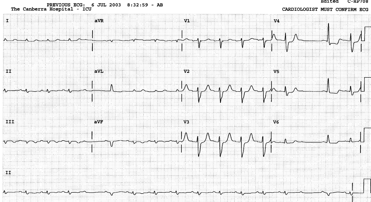 Inferior and general voltage loss is equivalent to Q waves.