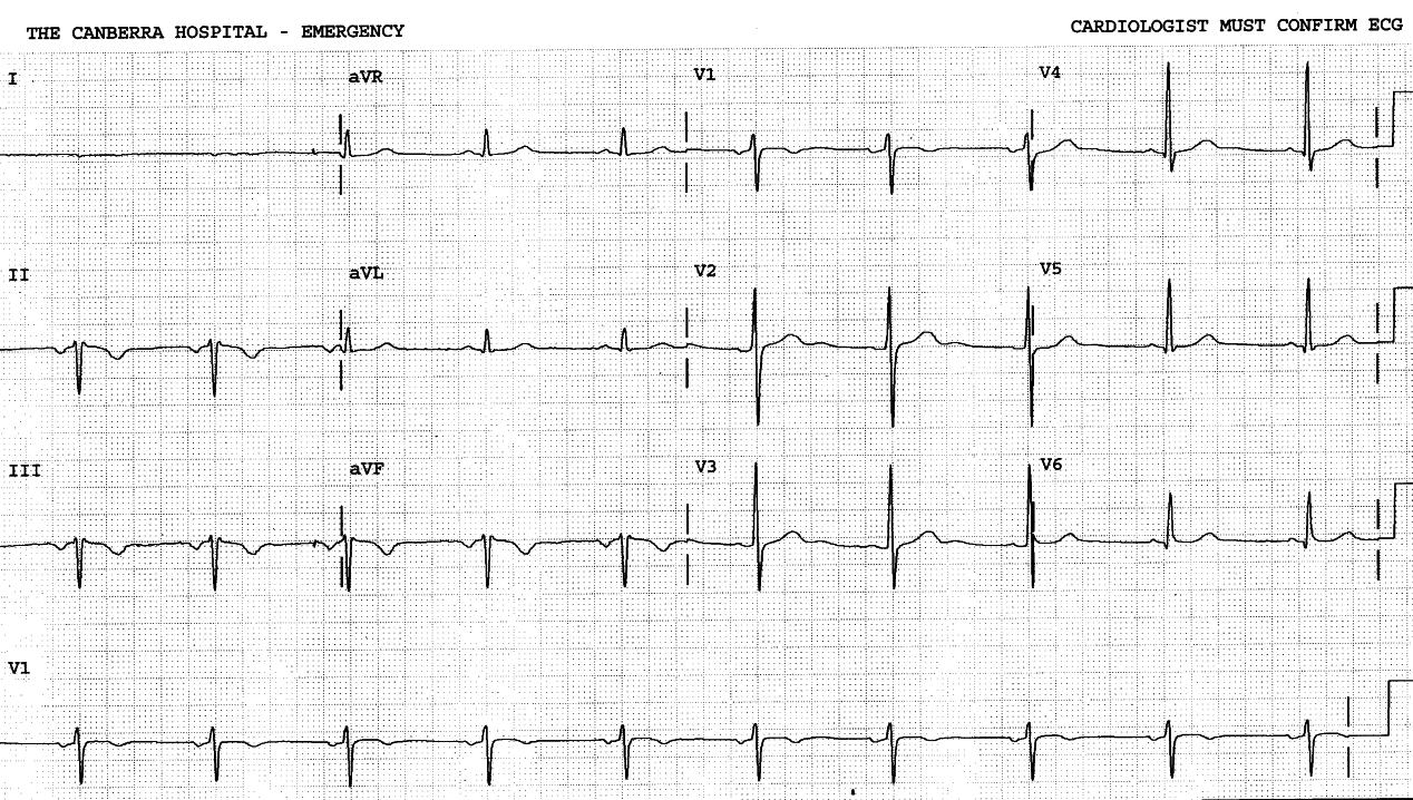 Routine pre-anÃ¦sthetic ECG on a 58 year old man with no known heart disease