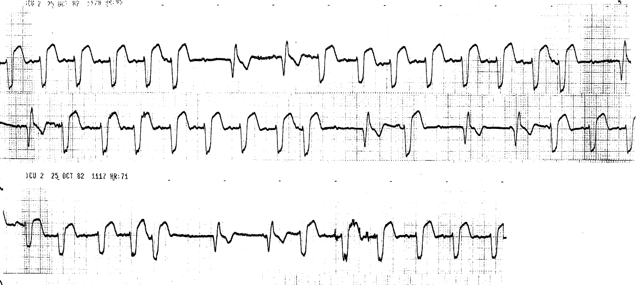 Different patient. SVEBs here cause immediate     2o AVB for the sinus P wave in their pause. The conducted     beats are all LBBB, the escape beats, characteristically, have     contralateral BBB morphology, viz. RBBB. The SVEBs may well be     junctional, main-stem extrasystoles.  