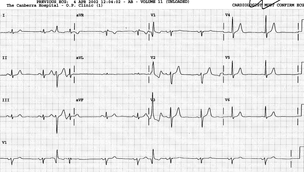 Asymtomatic 75 year old man who slowed down to speed up. 