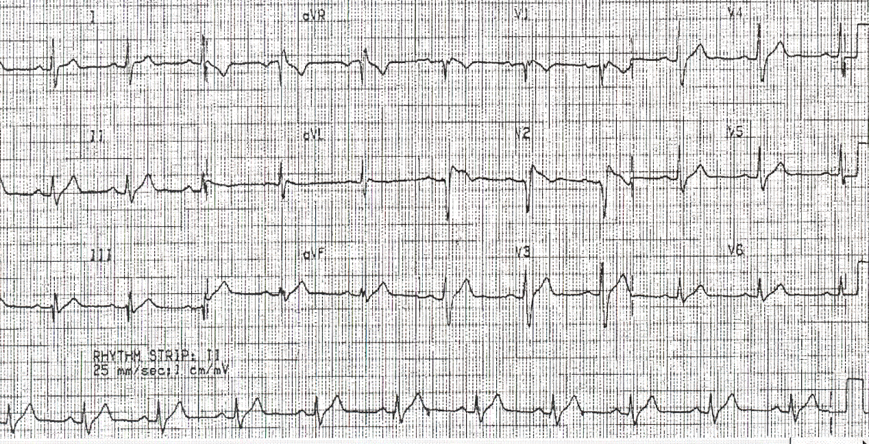 24 year old man with recent syncopal episodes, about to be discharged home and die