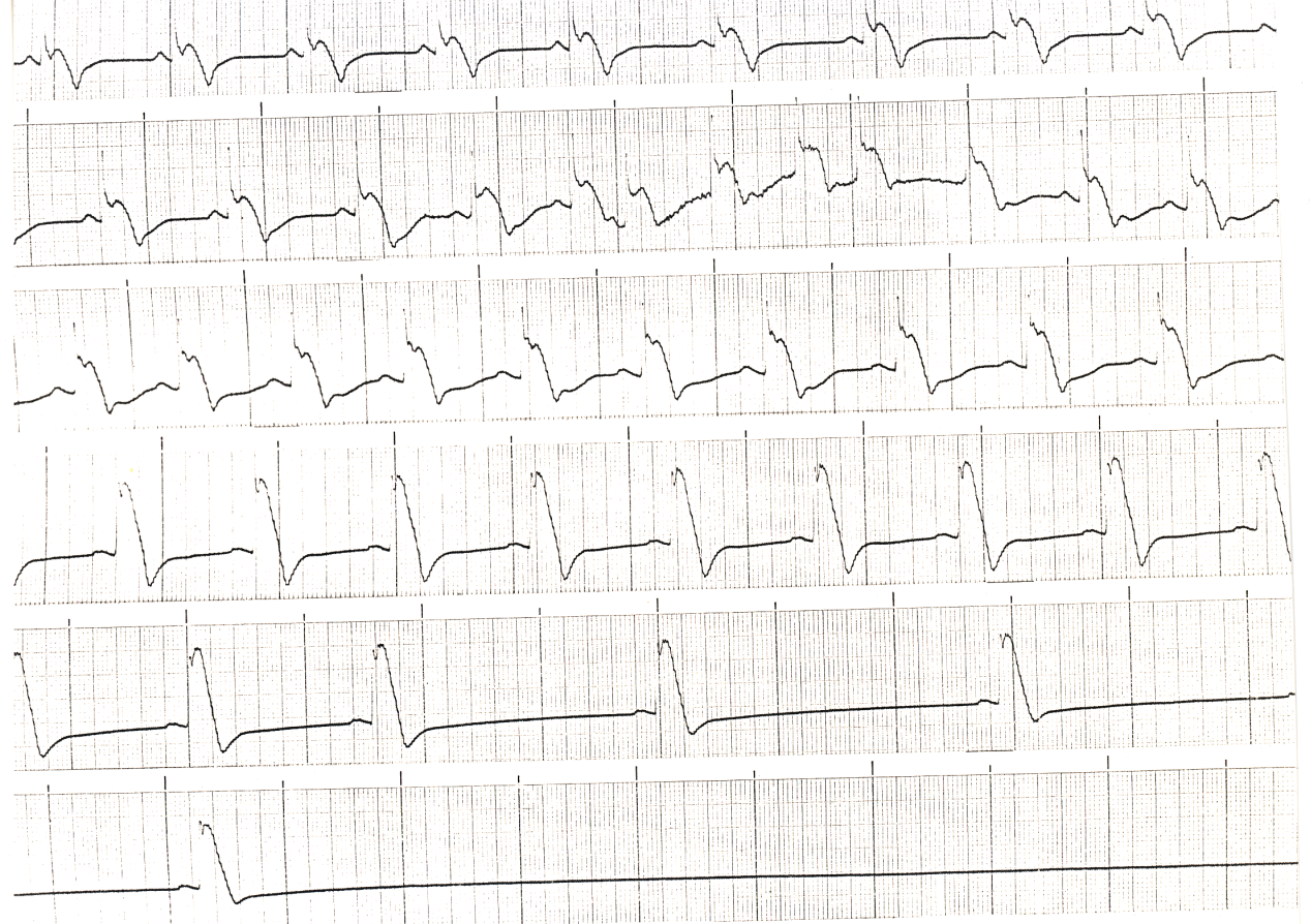 Same patient as 185b; progressive ST elevation