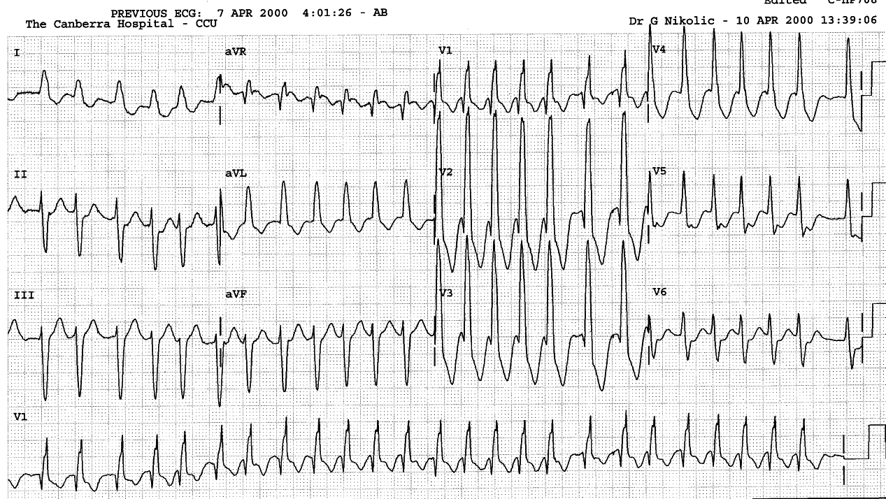 RBBB conduction in AF with RVR.