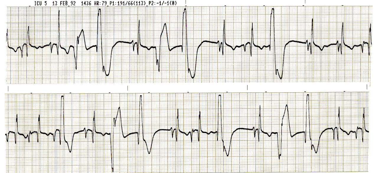 VEBs, some in dimorphic couplets suspected of causing the     pseudoblock in Fig 18. 