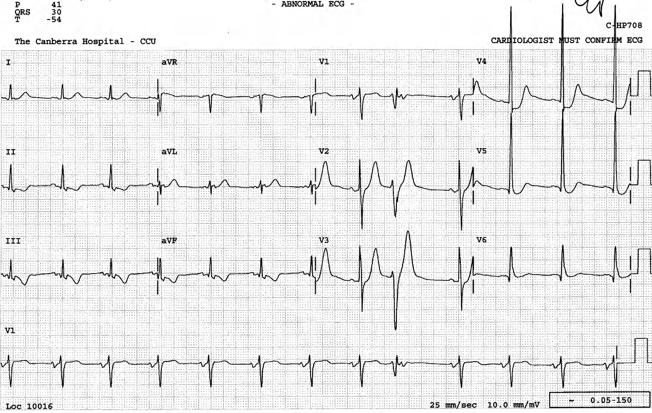 Sinus rhythm ECG, post-cardioversion. The early beat in V1 could be aberrantly conducted junctional one, with blocked sinus P wave closely following. The delay to the nadir of its S wave is in favour of ventricular ectopic origin. This cannot be taken any further. 