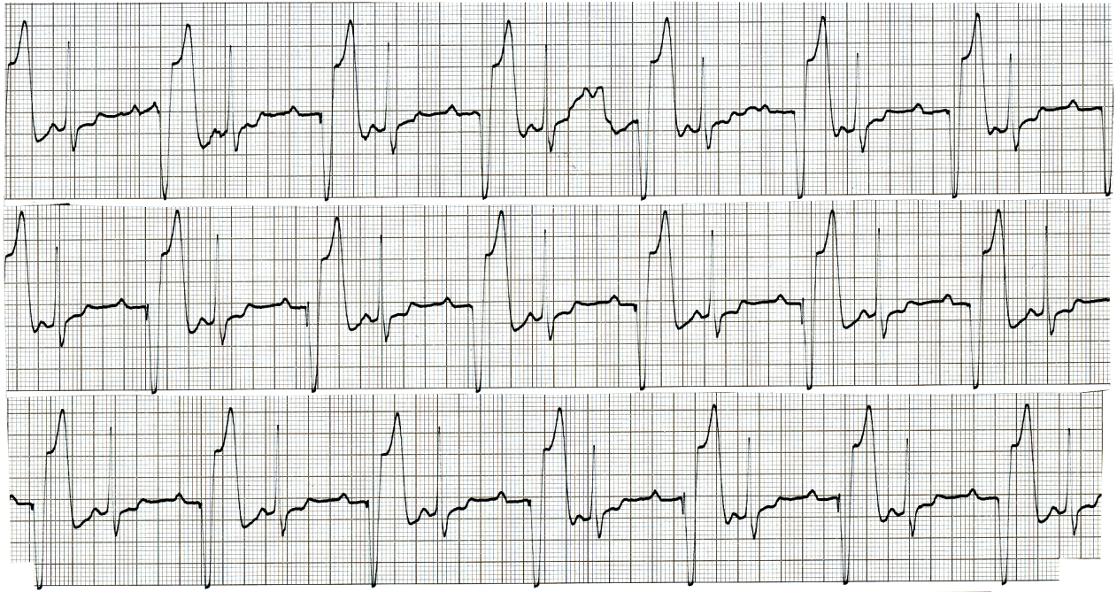 79 year old with episodic dizziness. The two broad complexes have something in common: oneâs concealing it, the other showing it for (almost) all to see. 