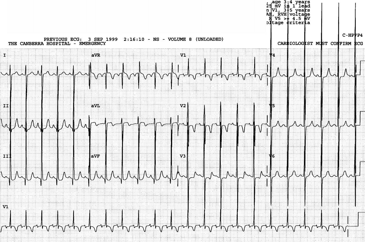 Cyanosed 4 year old girl born with VSD and pulmonary atresia. She had palliative surgery in the past