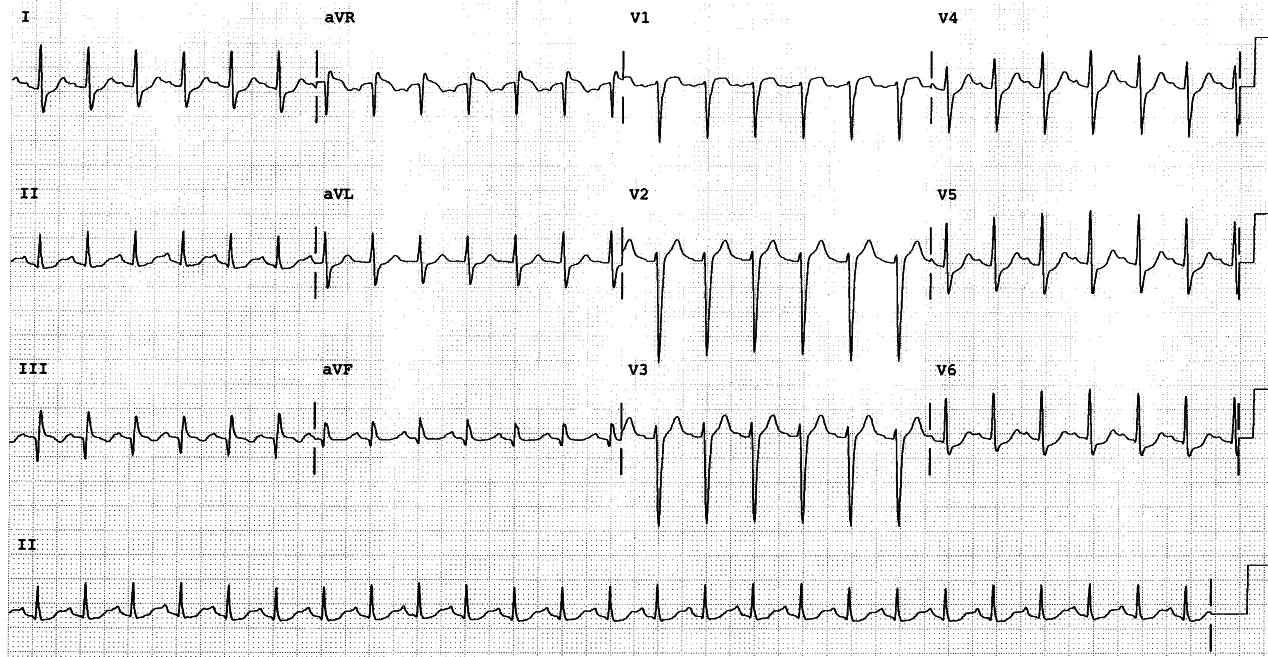 Breathless and hypotensive 39 year old man with extensive leg and thigh thrombophlebitis. The CXR is clear, as is the diagnosis.