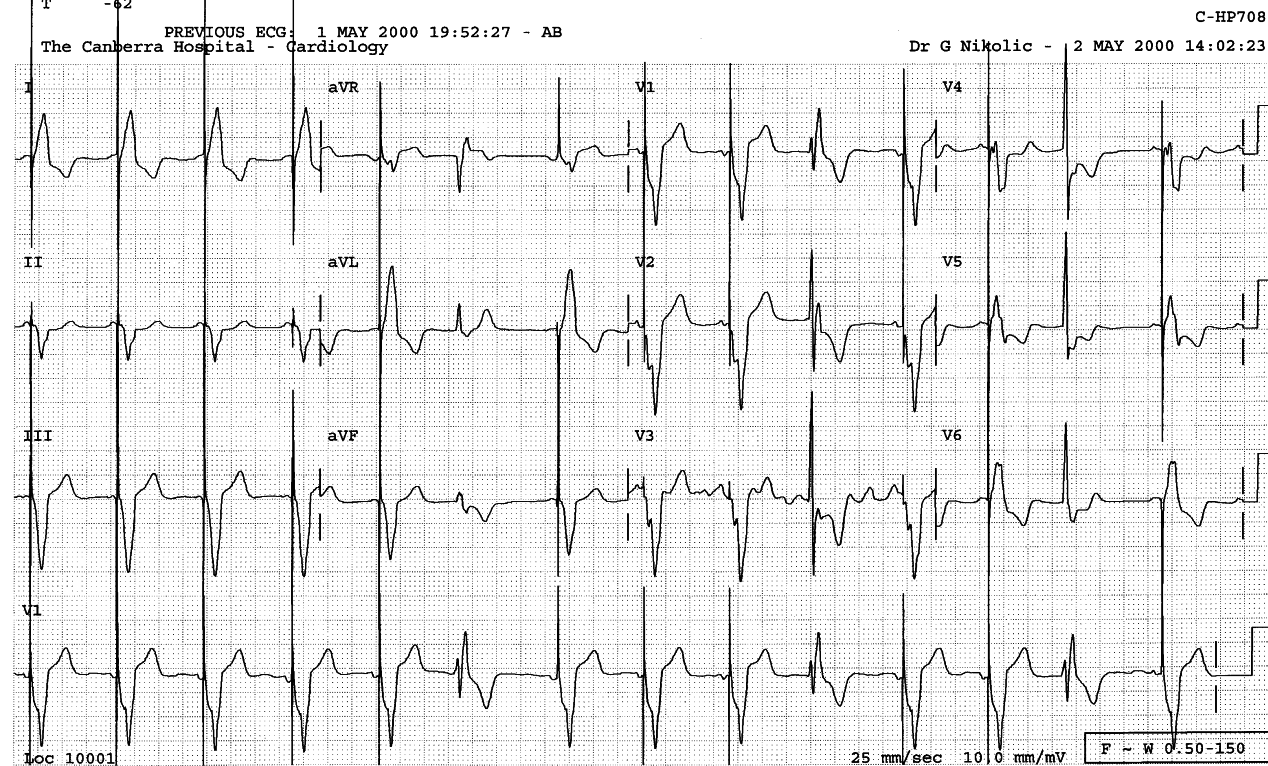 58 year old man with permanent pacemaker since aortic valve
replacement (AVR) five years previously.