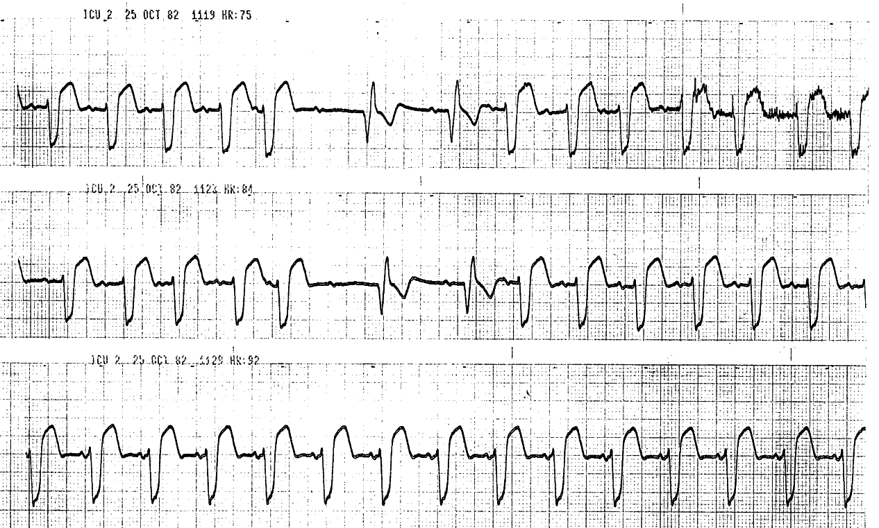 Further examples of SVEB-induced AVB. The bottom     strip has different P waves and shorted PR intervals â perhaps an     accelerated (idio)junctional rhythm. 