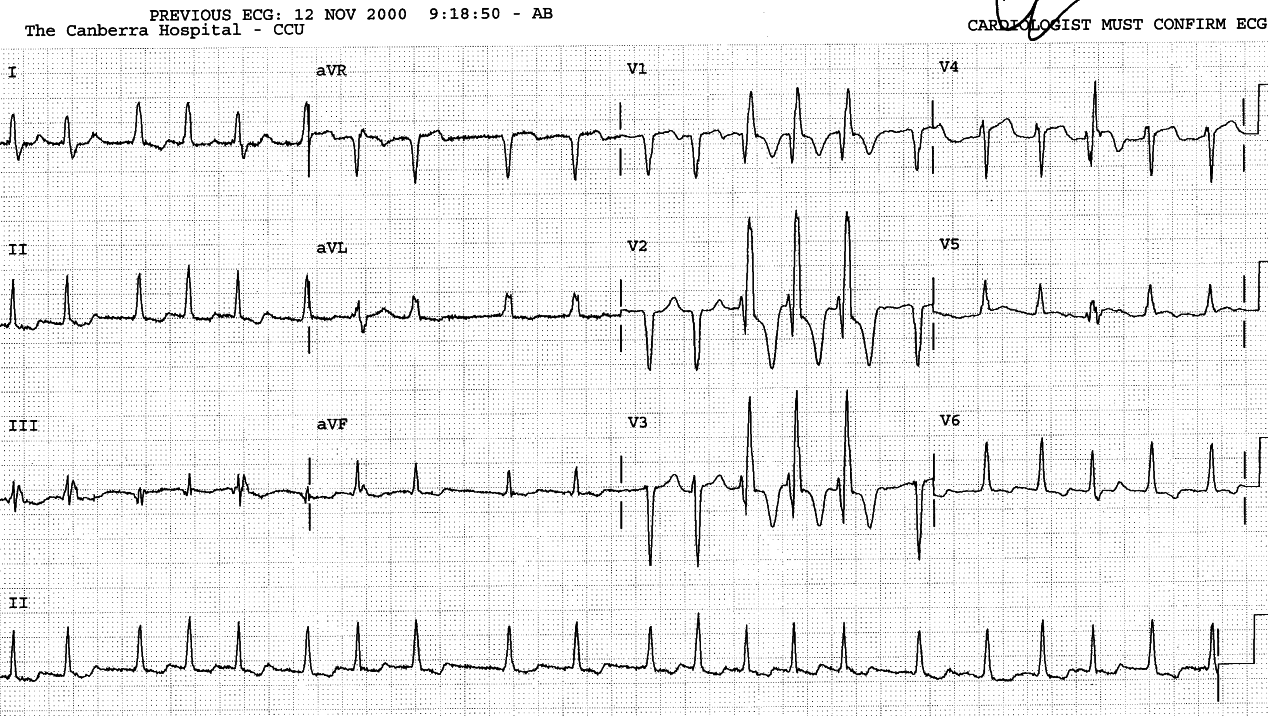 83 year old man in CCU for control of his arrhythmia