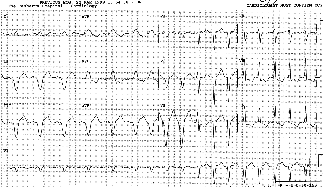 85 year old man in CCU for recurrent arrhythmia.