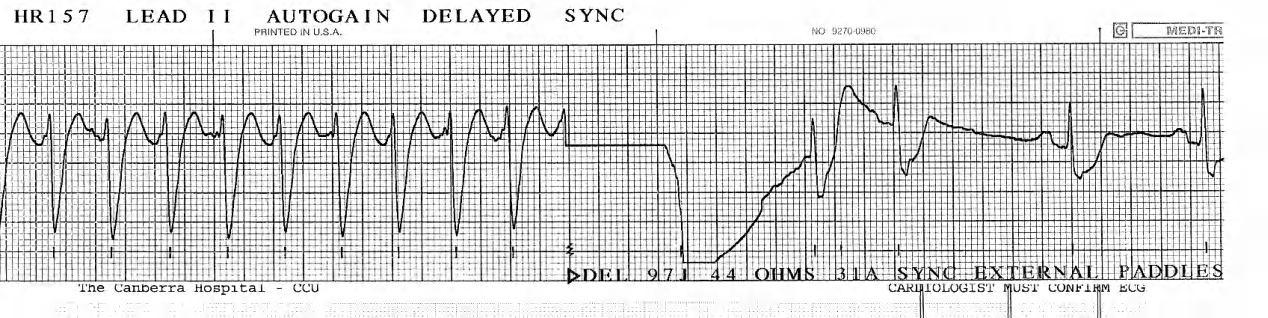 This is one of the gladdest sights in electrocardiography. 