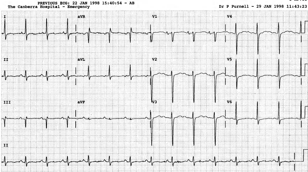 Comparison ECG in sinus rhythm. 