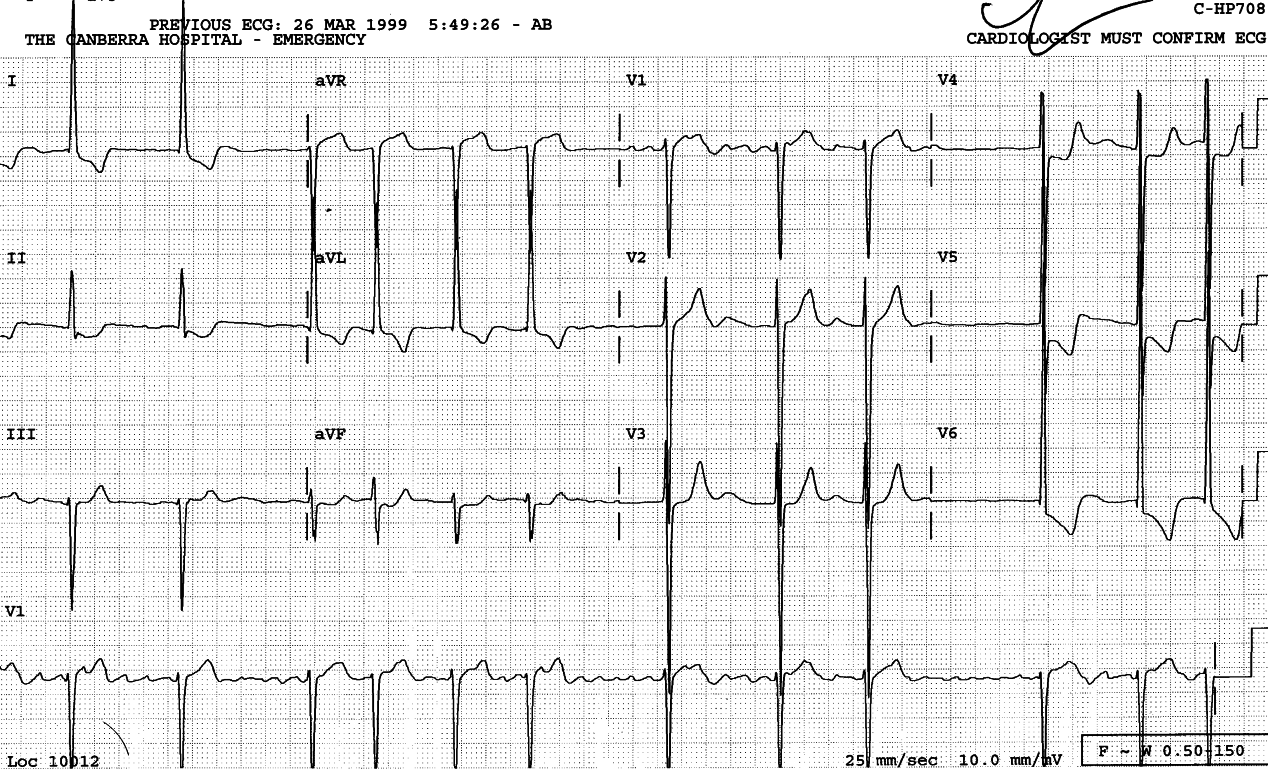 AF with âcontrolledâ ventricular response 78/min.