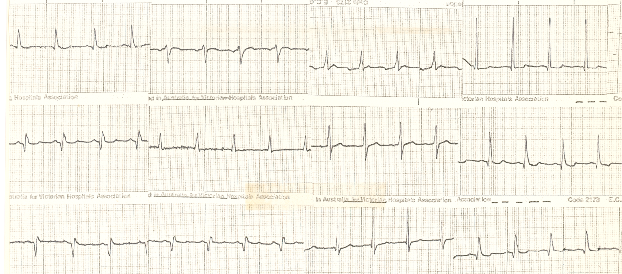 67 year old man with history of remote MI and atypical chest pains on current dmission