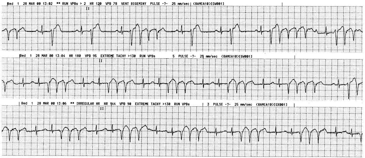 78 year old lady from a nursing home, with recent     infarction and frequent arrhythmias. 