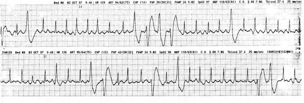 Milrinone, 50 Î¼g/Kg/min, increased the cardiac index from 2.0 to 2.6 L/min/M2 in this 69 year old man dying in cardiogenic shock from a large basal infarction. 