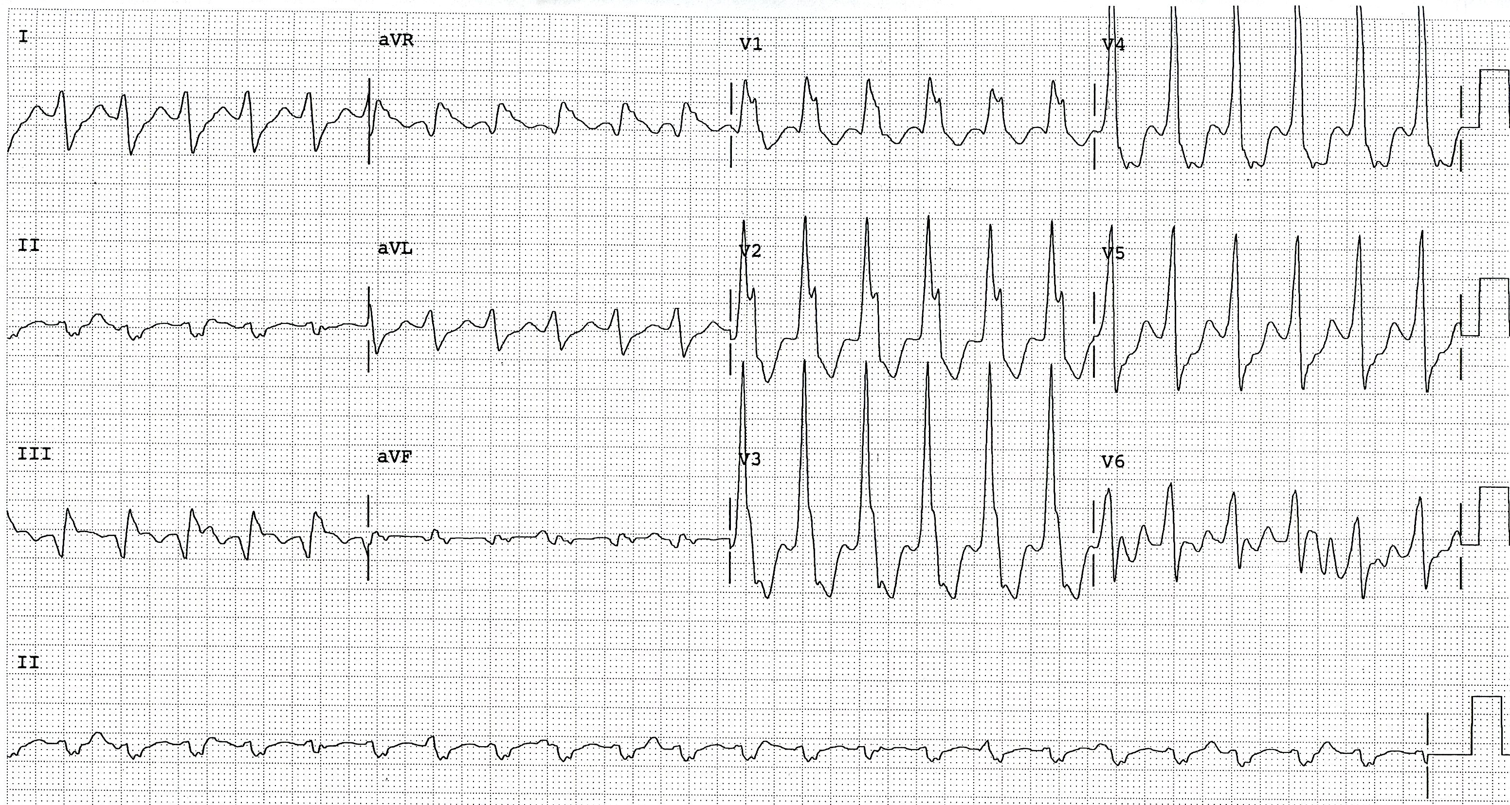 Positive, probably sinus, P waves marching through the VT. 