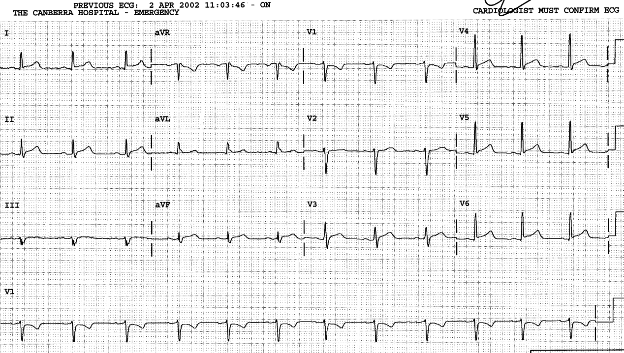 21 year old man with âpleuriticâ but central chest pain