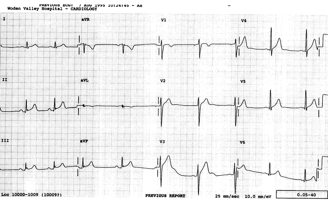 Healthy 27 year old male nurse with atypical chest pain.