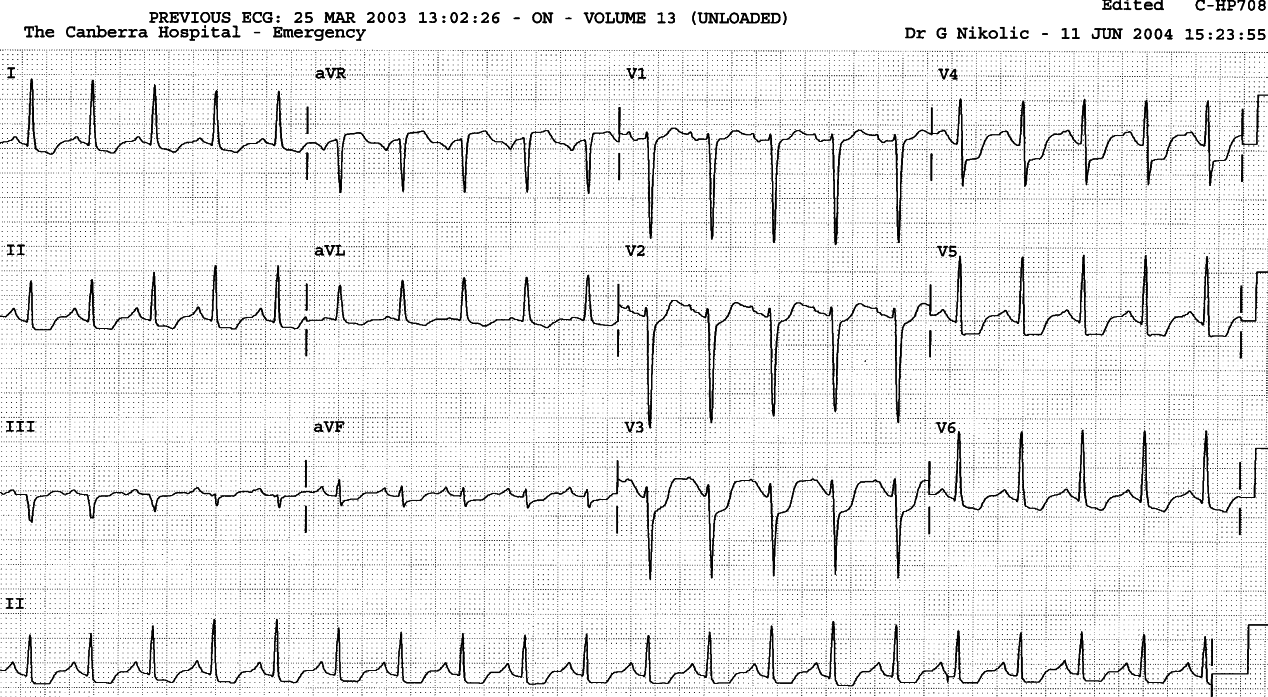 Admission ECG.