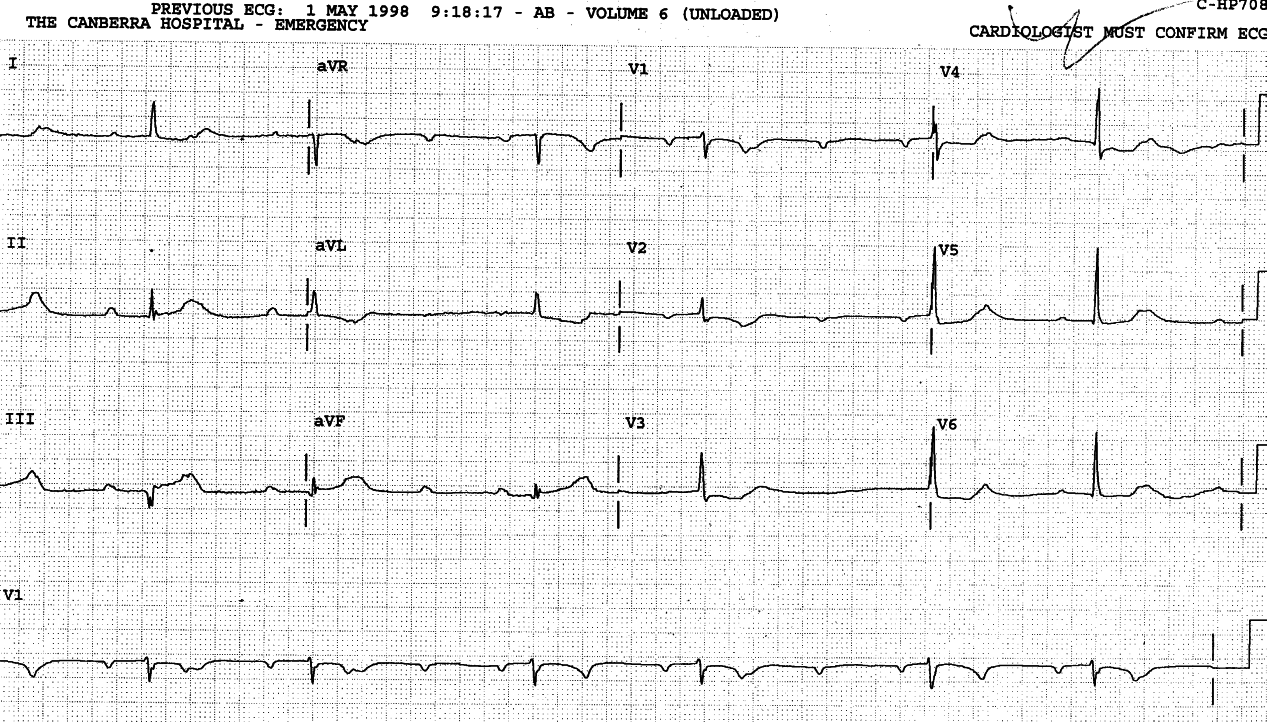 Same patient. Alternating 2:1 and 3:1 AVB or escape-capture     bigeminy? I incline toward the former. 