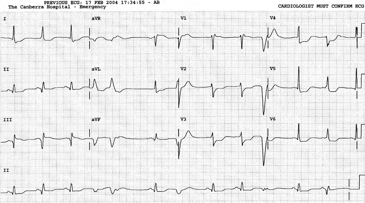 The two fusion beats have slightly shorter PR intervals than âpureâ sinus complexes. 