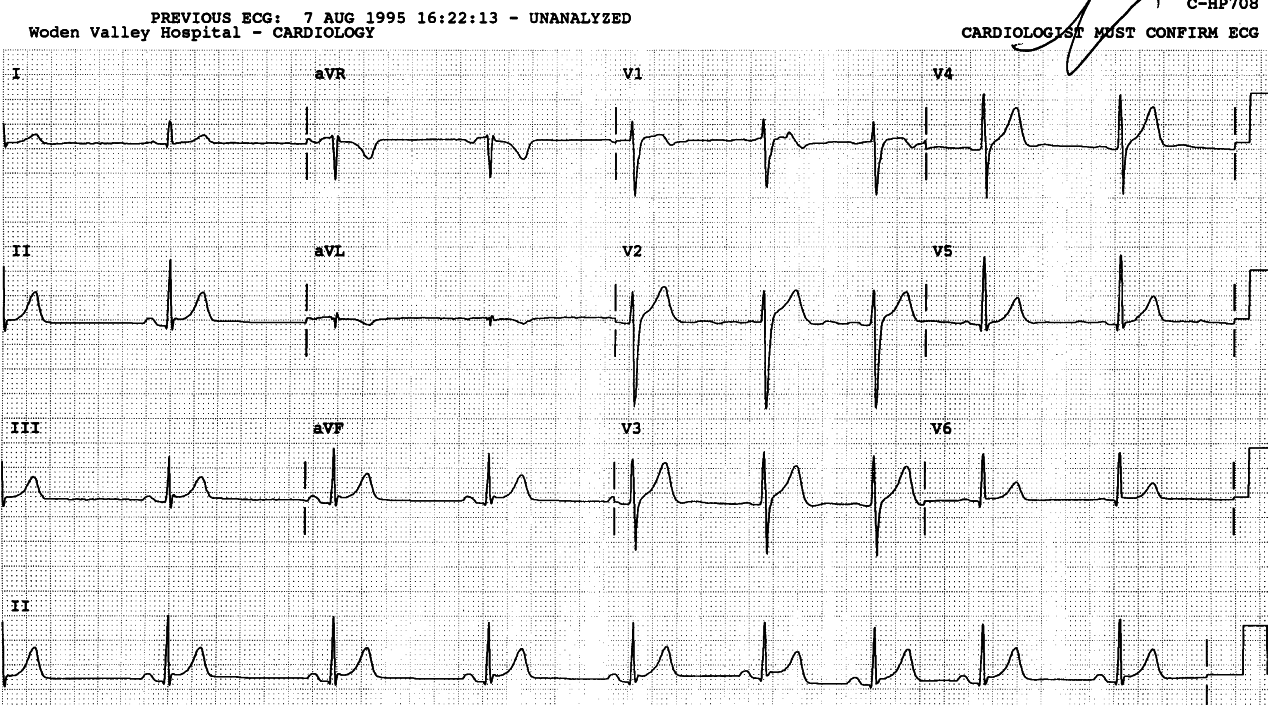 Sinus arrhythmia and early repolarisation persist.