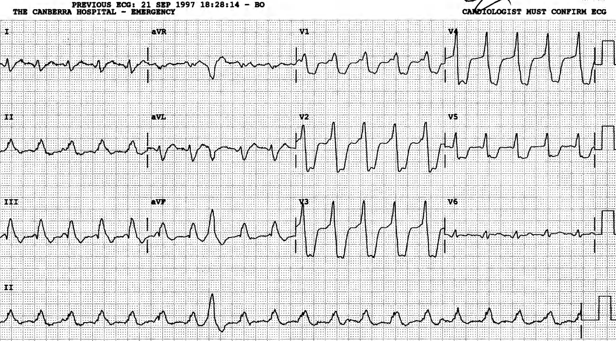 Monomorphic VT with a VEB â or not monomorphic, the odd beat being part of it? 