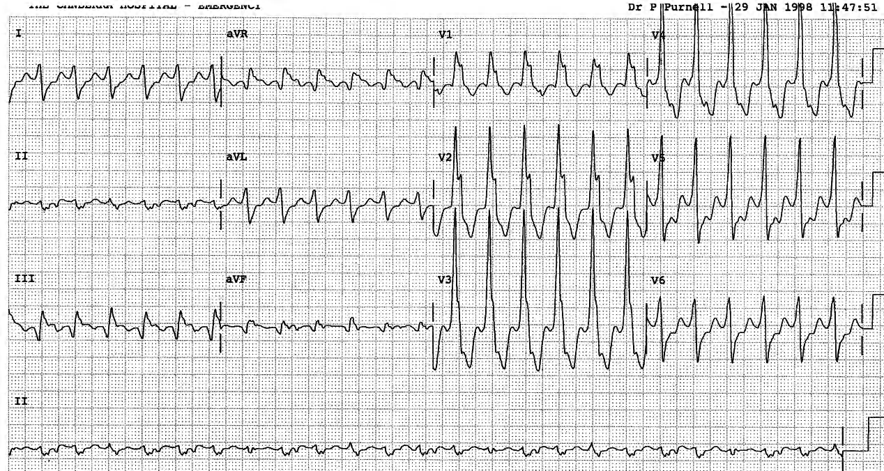 Retrograde P waves following some and perhaps buried in other VT complexes. 