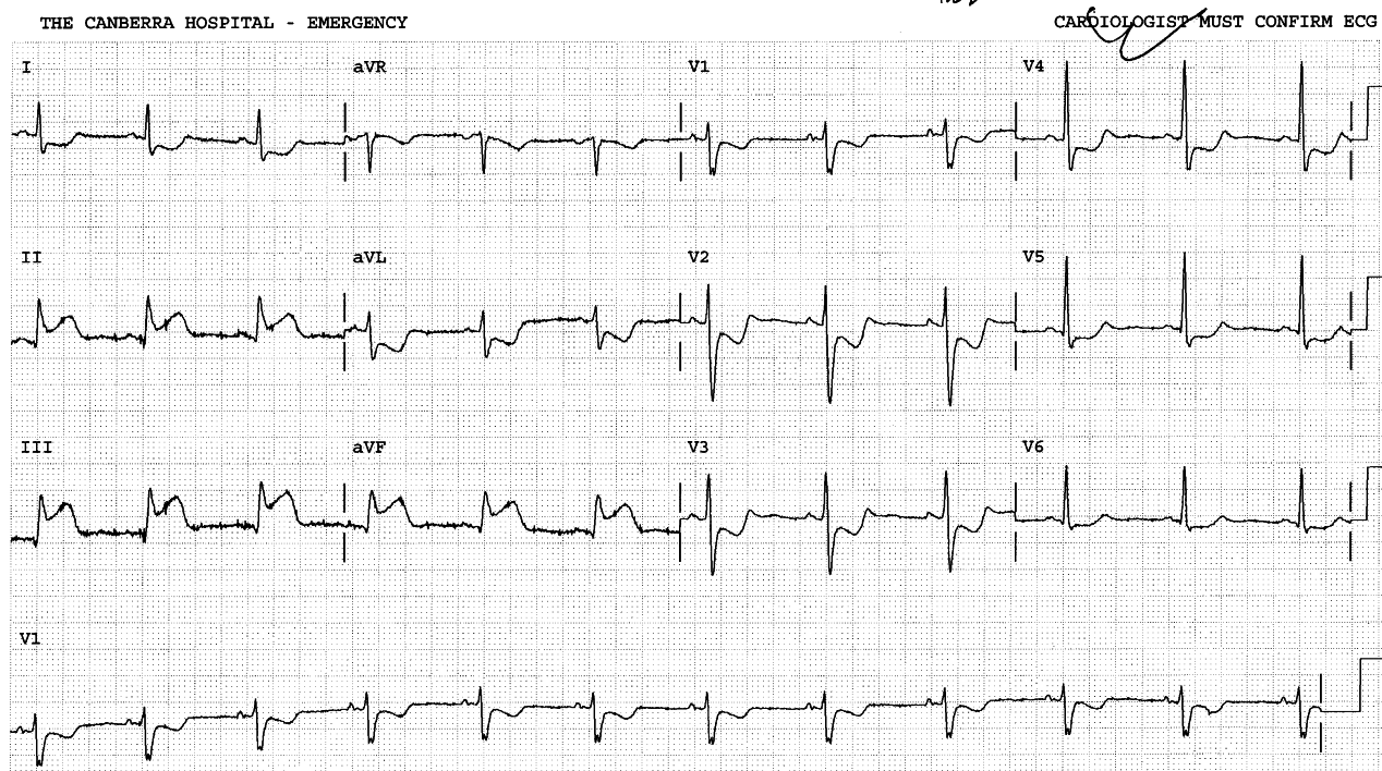 Admission ECG in Casualty. Acute inferior MI.