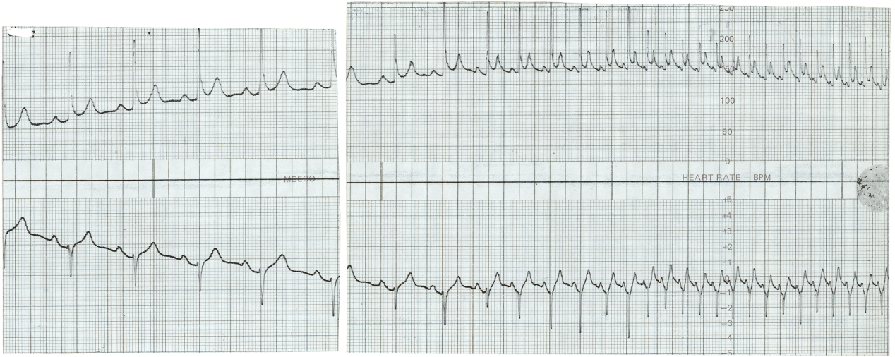 Continuous 2-channel Holter strips on a 55 year old lady with recent AF and digoxin toxicity