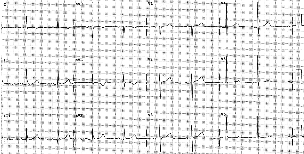 Discrete 2:1 AVB, but what about V4-5? Also, the T
waves are not normal, V1 exceeding V6 and 1 and
aVL inverted.