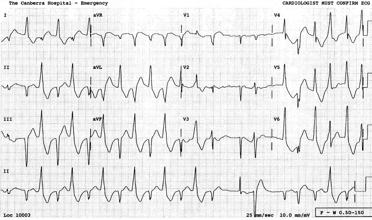 81 year old lady on regular digoxin therapy for congestive heart failure, admitted with pneumonia. 