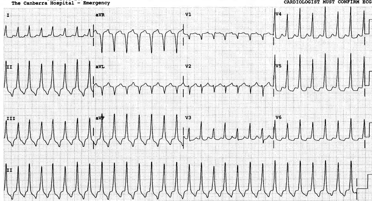 65 year old man with chronic renal failure, admitted for insertion of an A-V shunt for dialysis; there is no cardiac history. He now has presyncopal spells. 