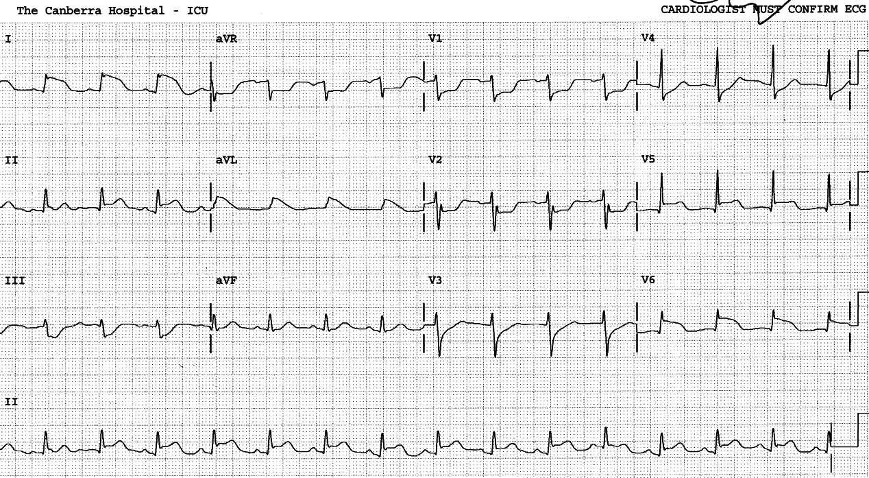 Ventilated 45 year old man with septic shock from Capnocytophaga canimorsus.