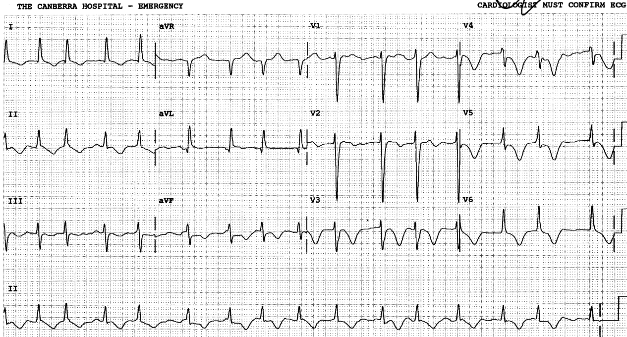 Global T wave inversion in AF.