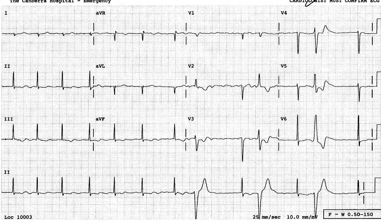 AF with âcontrolledâ response and an episode of ventricular bigeminy. 