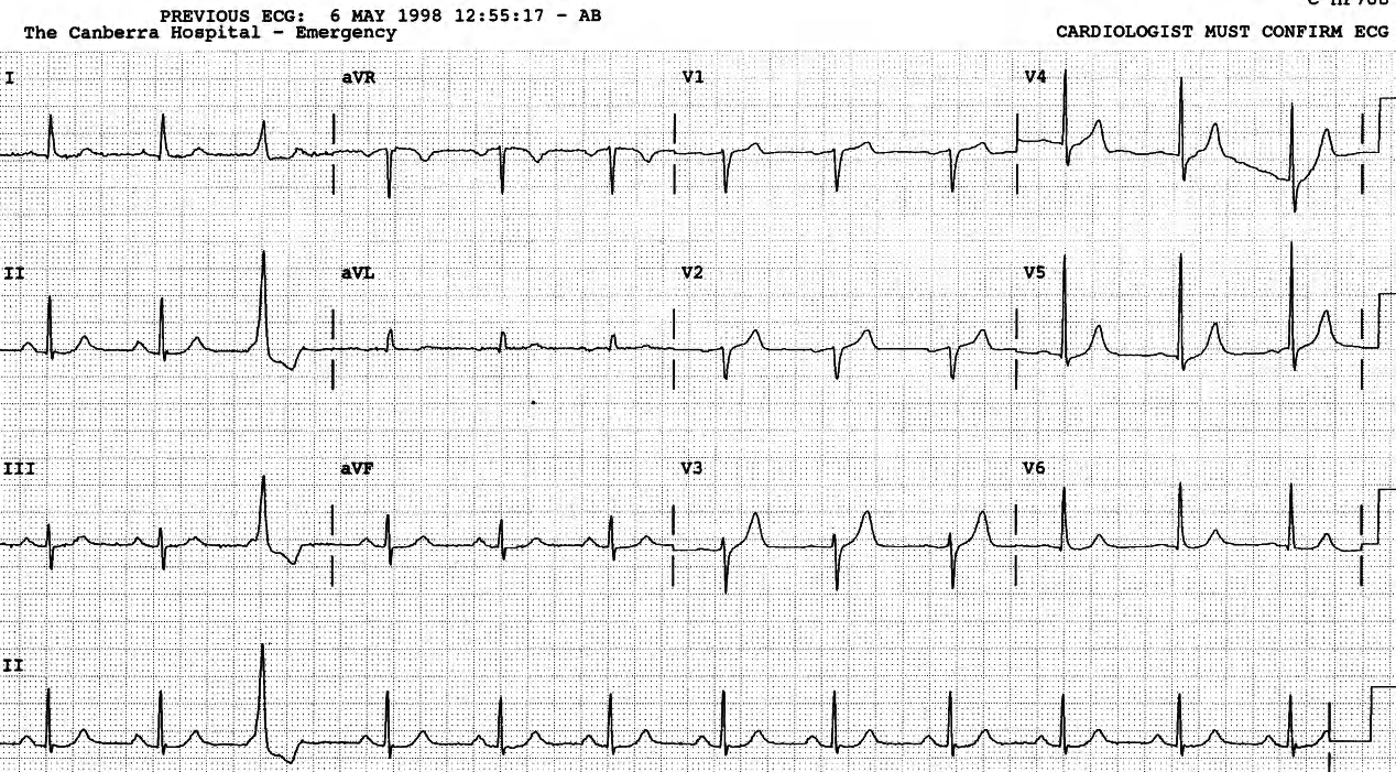 No one hesitates to diagnose a single VEB, but when they fill the whole trace, as in Fig 21, uncertainty often prevails: a decision has to be made. 