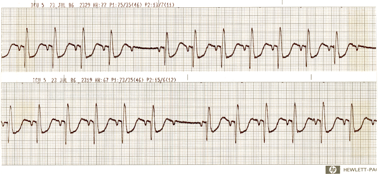 Sinus P waves are undisturbed except for sinus arrhythmia.