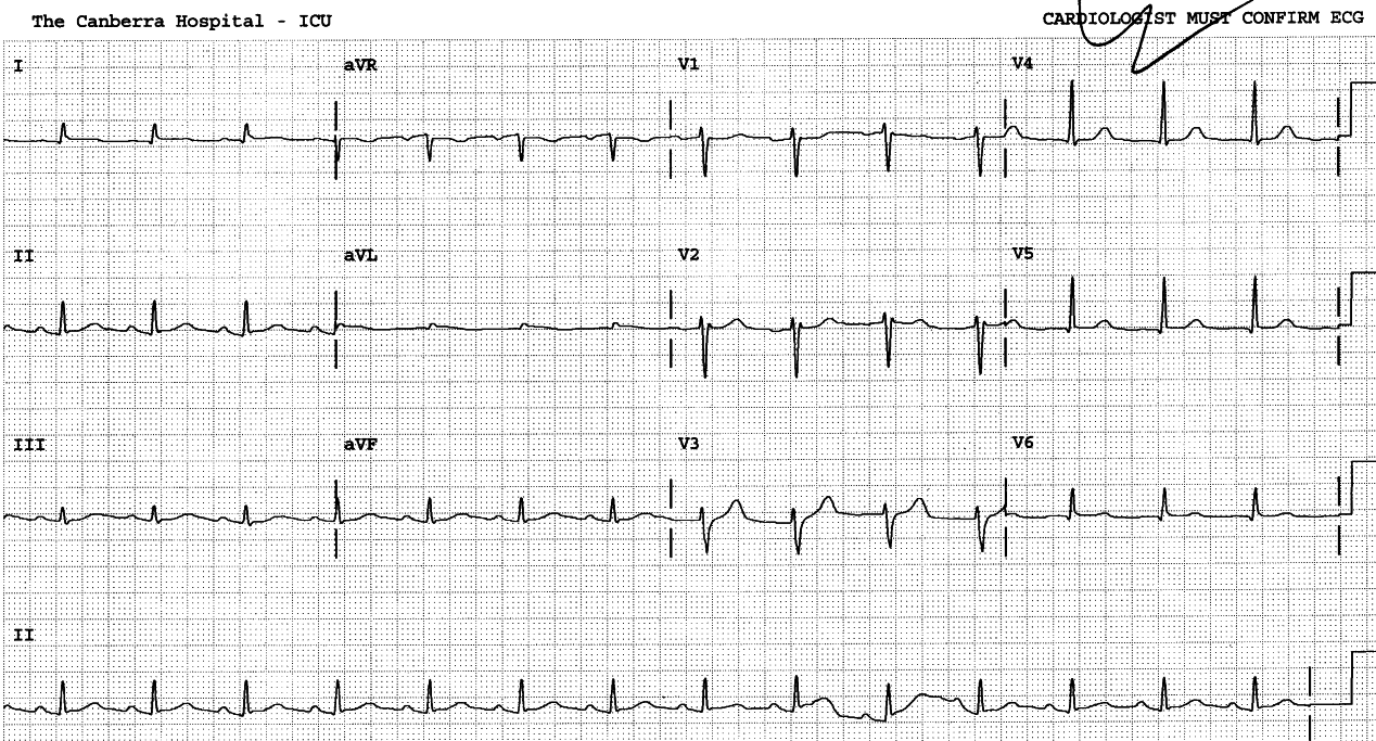 Leads 1 and aVL are still slightly abnormal, the other leads normalised.