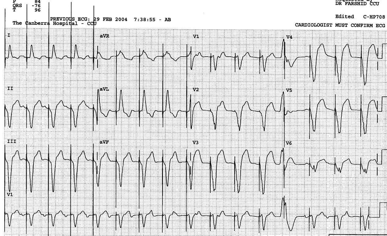 44 year old man in CCU with heart failure and malfunctioning
pacemaker.