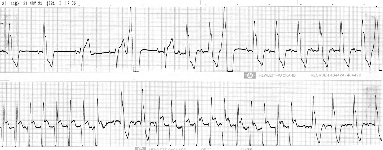 A 70 year old man in biventricular failure following delayed aortic valve replacement. 