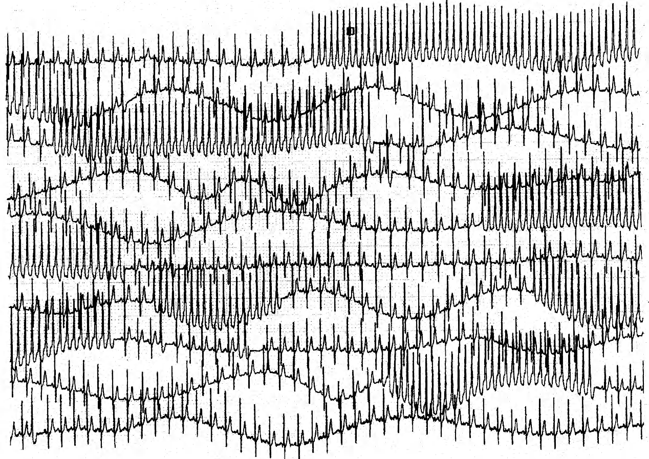 A Holter recording of frequent non-sustained VT runs. 